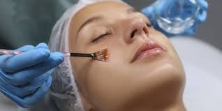 Chemical Skin Peel